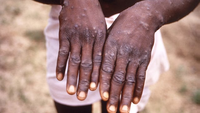 Viruela del mono. Foto: Brian W.J. Mahy / Centers for Disease Control and Prevention / AFP.
