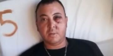 El hincha de Gimnasia que podría perder un ojo