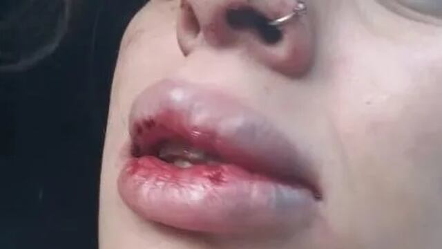 La mujer tuvo que ser hospitalizada con escoriaciones, politraumatismos y heridas en el rostro.