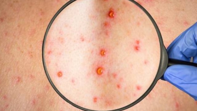 Brote de varicela en Entre Ríos: ya suman 700 casos y la mayoría afecta a adolescentes