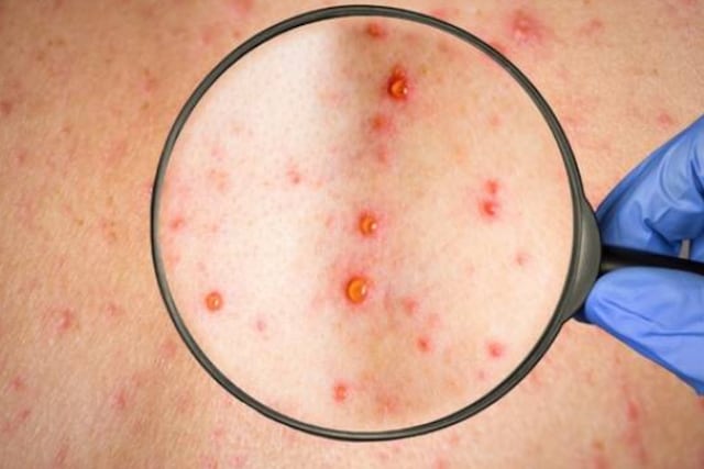 Brote de varicela en Entre Ríos: ya suman 700 casos y la mayoría afecta a adolescentes