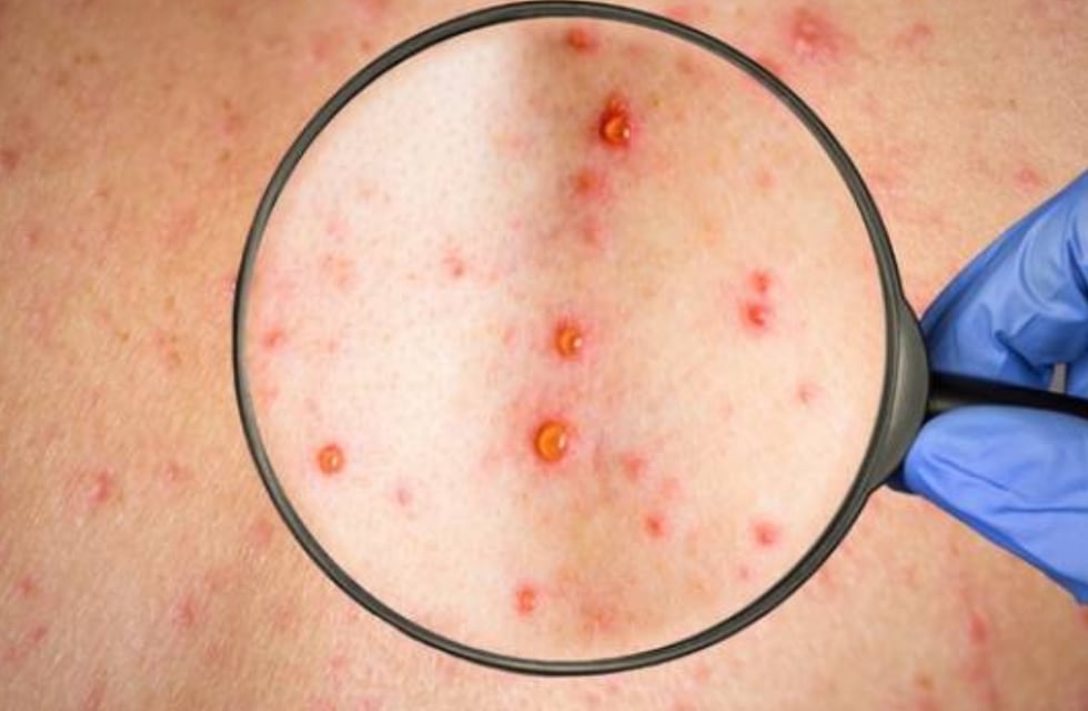 Brote de varicela en Entre Ríos: ya suman 700 casos y la mayoría afecta a adolescentes