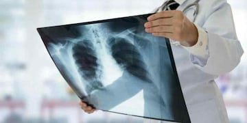 La tuberculosis sigue siendo una enemiga silenciosa.