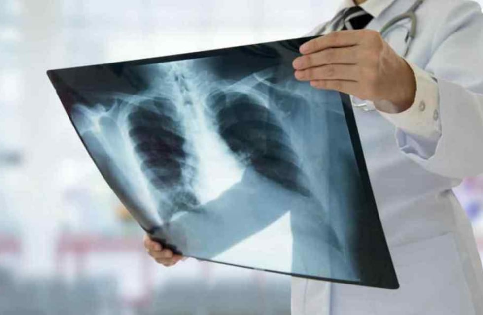 Alerta en Córdoba por un aumento de casos de tuberculosis