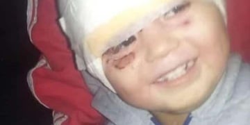 Él es Ángel Damián, el bebé sanjuanino que sufrió quemaduras con aceite hirviendo en su rostro.