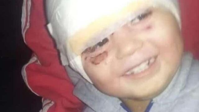 Él es Ángel Damián, el bebé sanjuanino que sufrió quemaduras con aceite hirviendo en su rostro.