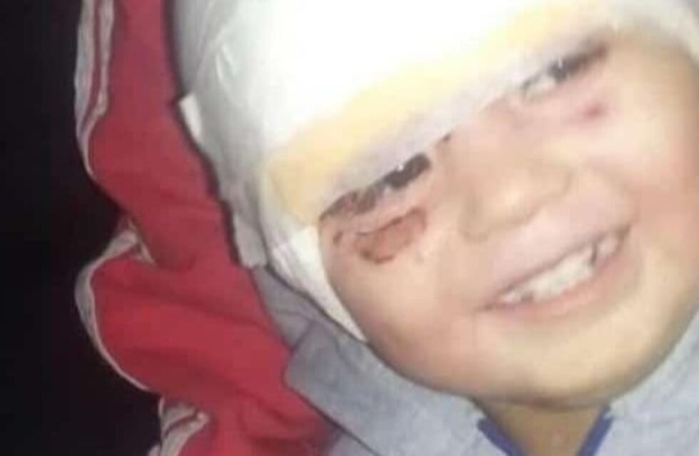 El bebé sanjuanino de un año que sufrió quemaduras con aceite en su cara ya recibió el alta
