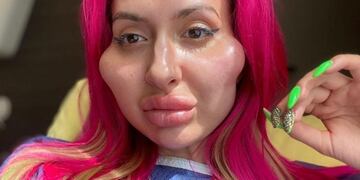 Anastasia Pokreshchuk y la obsesión por las cirujías de pómulos (Instagram)