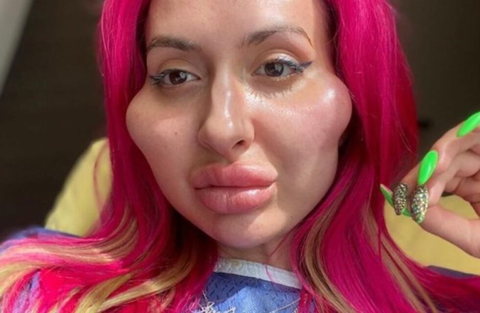 La obsesión de Anastasia: quiere alcanzar el récord de "las mejillas más grandes del mundo"