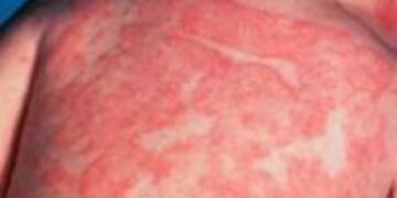 Dermatitis atópica crónica\u002E (WEB)