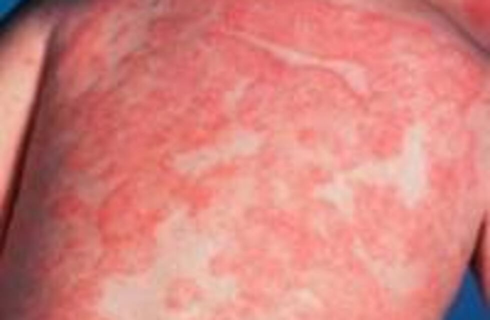 Una nena de Eldorado sufre dermatitis crónica y su familia pide ayuda