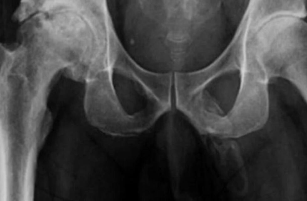 El extraño caso del hombre al que el pene se le está convirtiendo en hueso