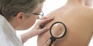 Chequeos cáncer de piel