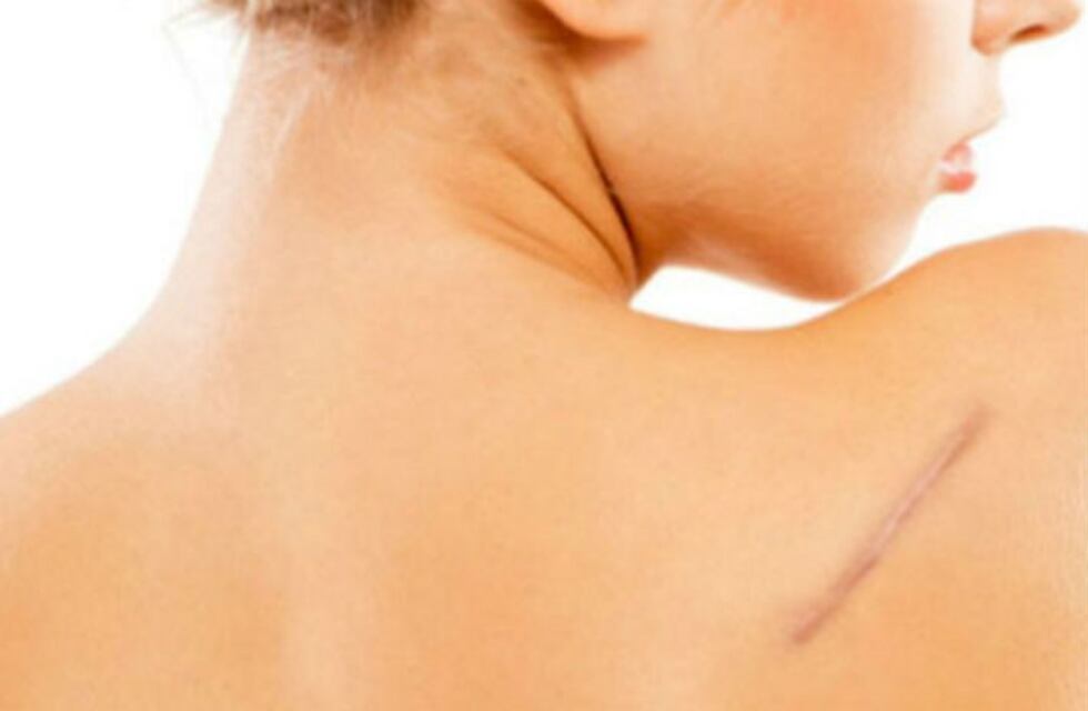 Por qué es importante cuidar las cicatrices en verano