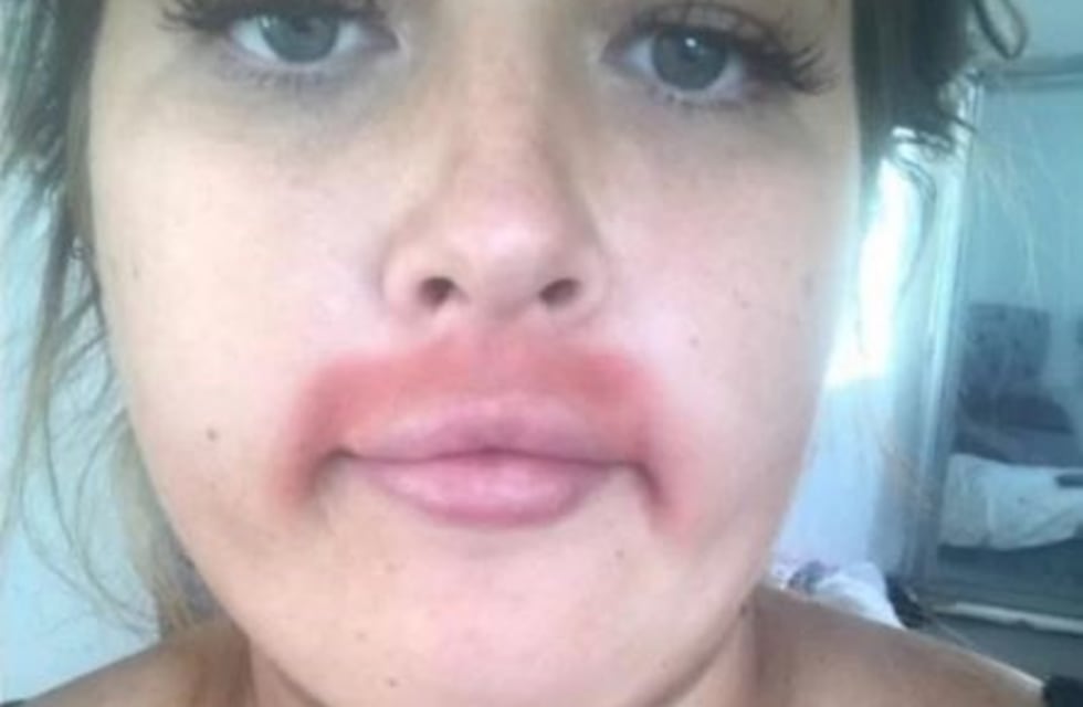 Usó una crema para depilarse, tuvo una reacción alérgica y se volvió viral