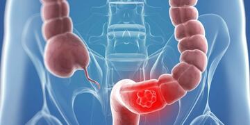 Charla abierta y gratuita sobre enfermedades del colon\u002E