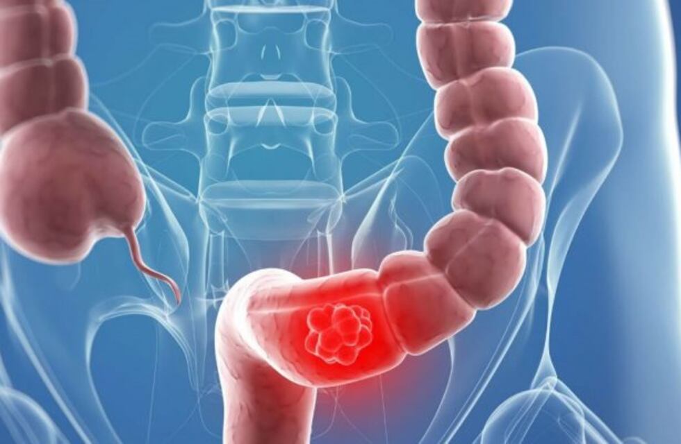 Campaña de atención gratuita contra el Cáncer de Colon