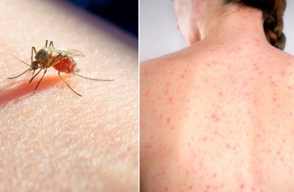 En Formosa hay 2788 casos de dengue según el Gobierno