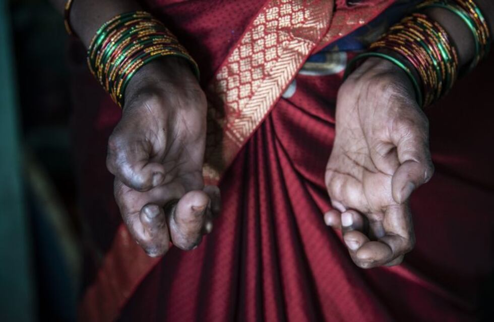 Detectan nuevos casos de lepra aunque la endemia disminuye