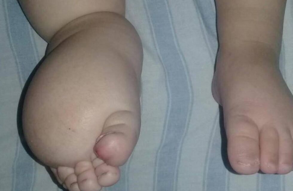 Una puntaltense de 2 años necesita ayuda por padecer Linfedema