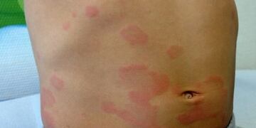 La extraña urticaria que se generalizó en Rafaela (Diario Castellanos)