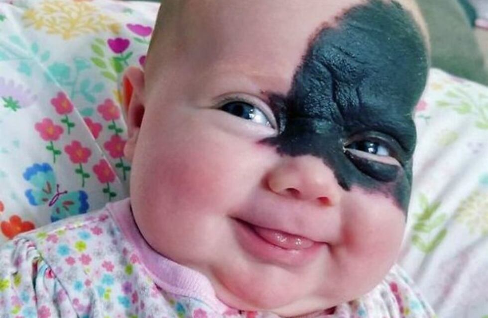 Nació con una mancha en la cara y la apodaron "pequeña superheroína"