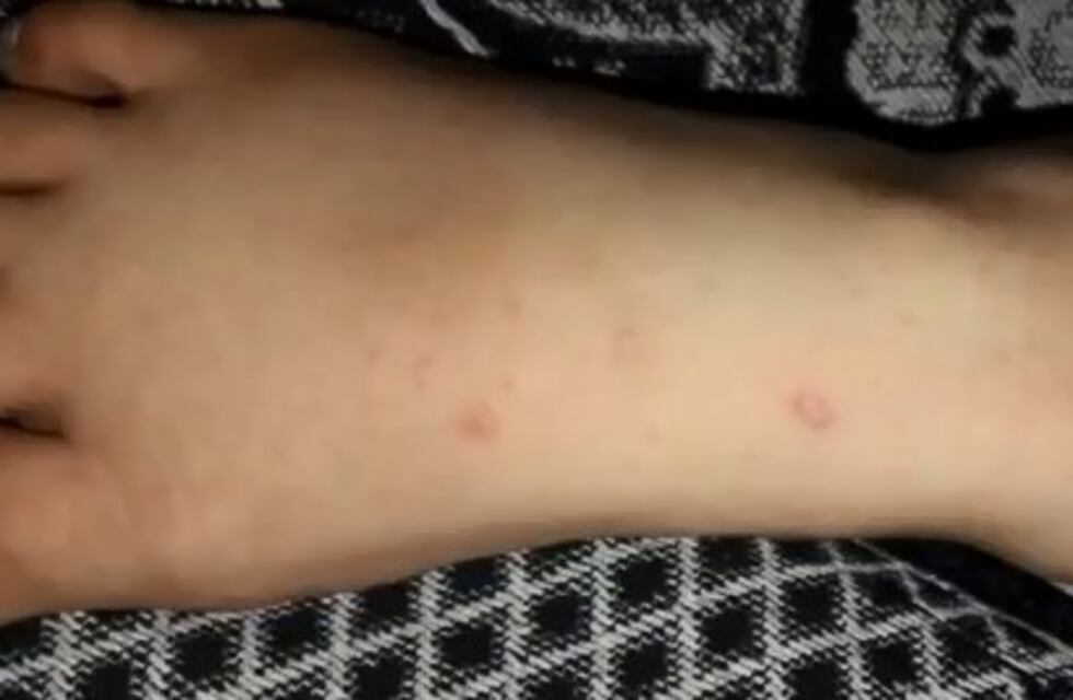 Denuncian casos de sarna en una escuela de zona oeste