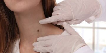 Campaña de Prevención de Cáncer de Piel en Alta Gracia