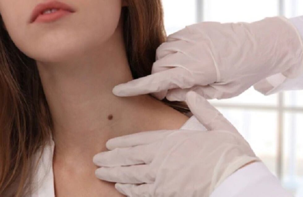 Campaña de Prevención de Cáncer de Piel en Alta Gracia