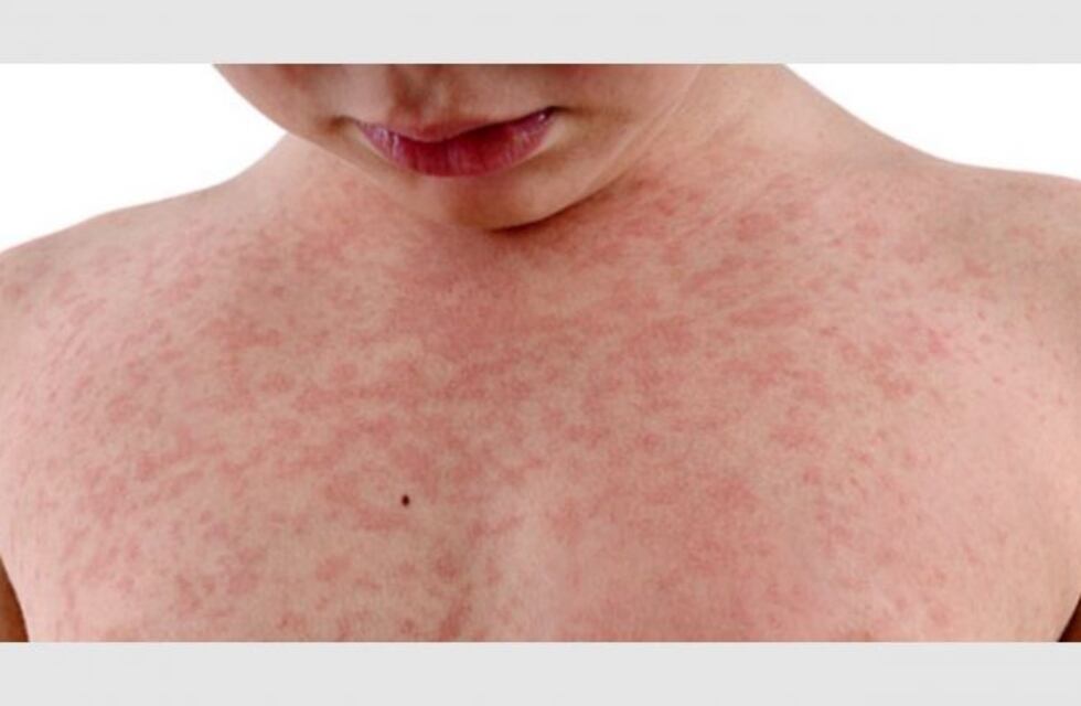 Preocupación en una escuela sanjuanina por casos de varicela y escarlatina