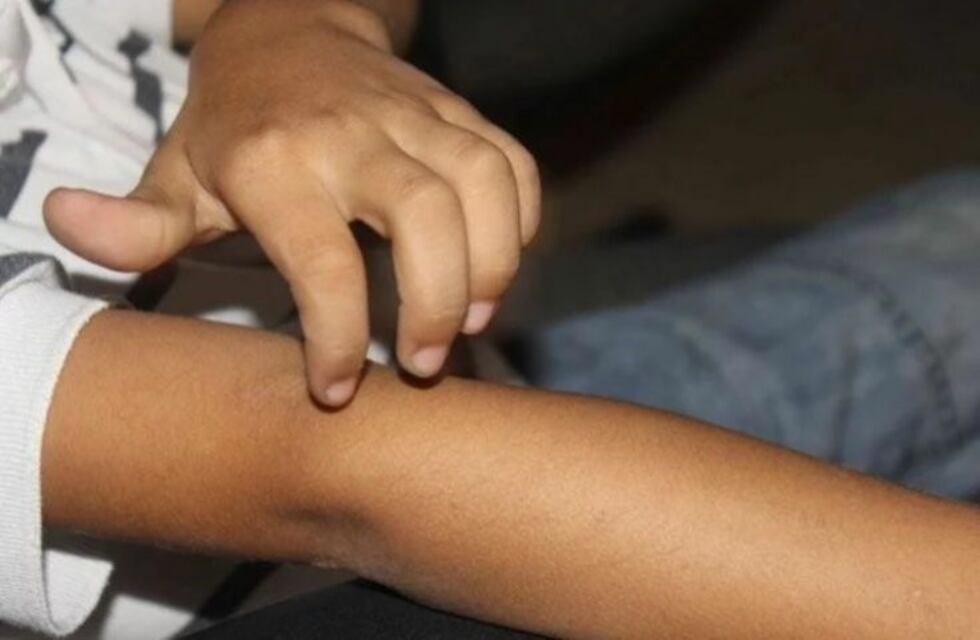 Registraron varios casos de sarna en escuelas de Concordia