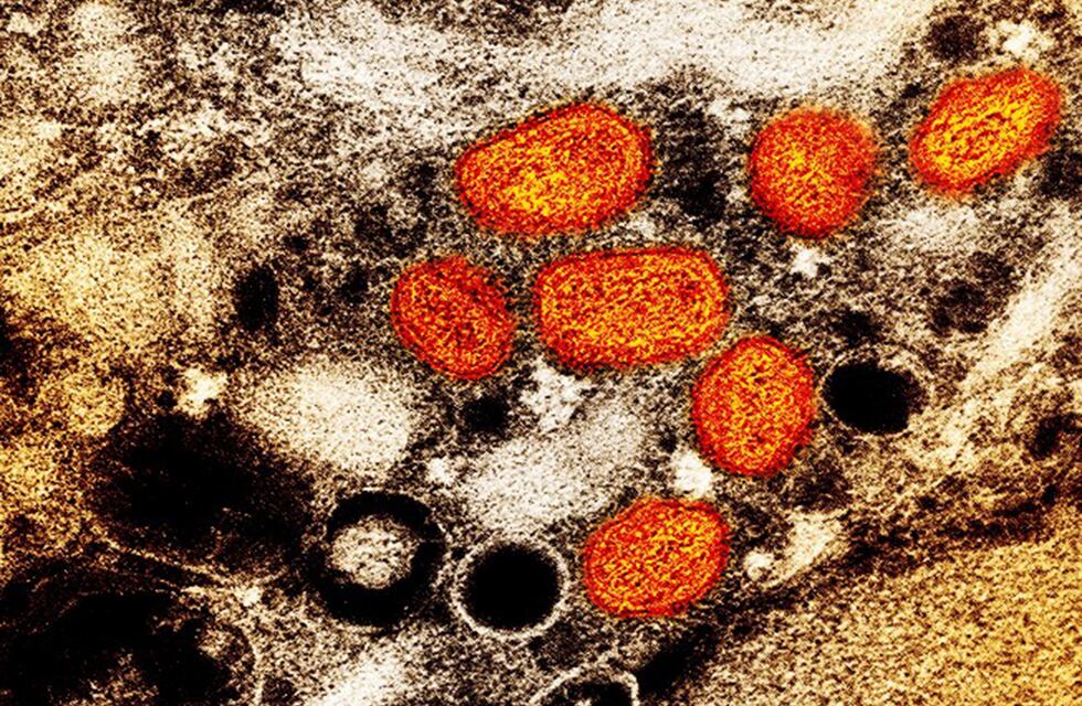 Viruela del mono: Santa Fe confirmó el primer caso en Rosario