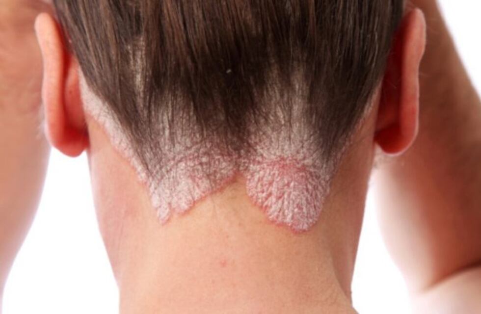 Lanzan campaña detección gratuita de Psoriasis en Rosario