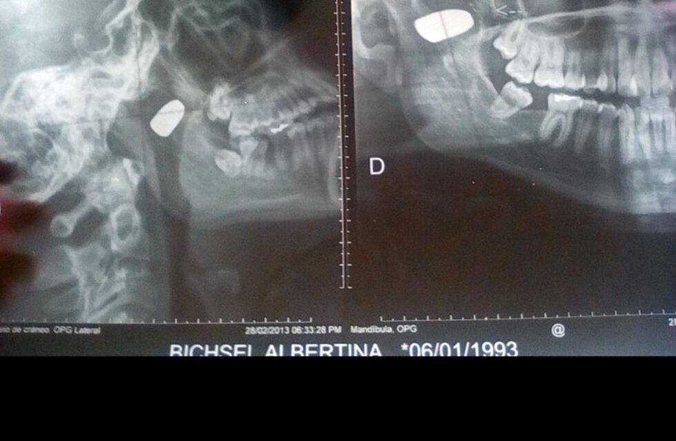 "Vivo con una bala en la cabeza que me disparó mi ex": una historia de resiliencia