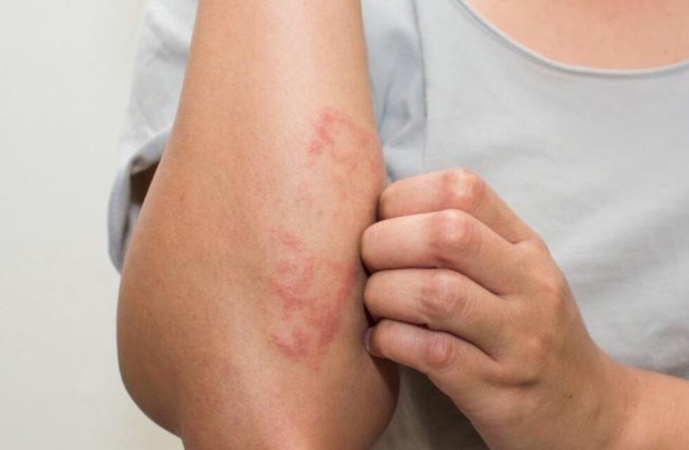 Se recuerda el Día Mundial de la Lepra un mal del cual se detectan 72 enfermos en Misiones