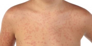 Confirmado: un caso de rubéola en el sur provincial\u002E