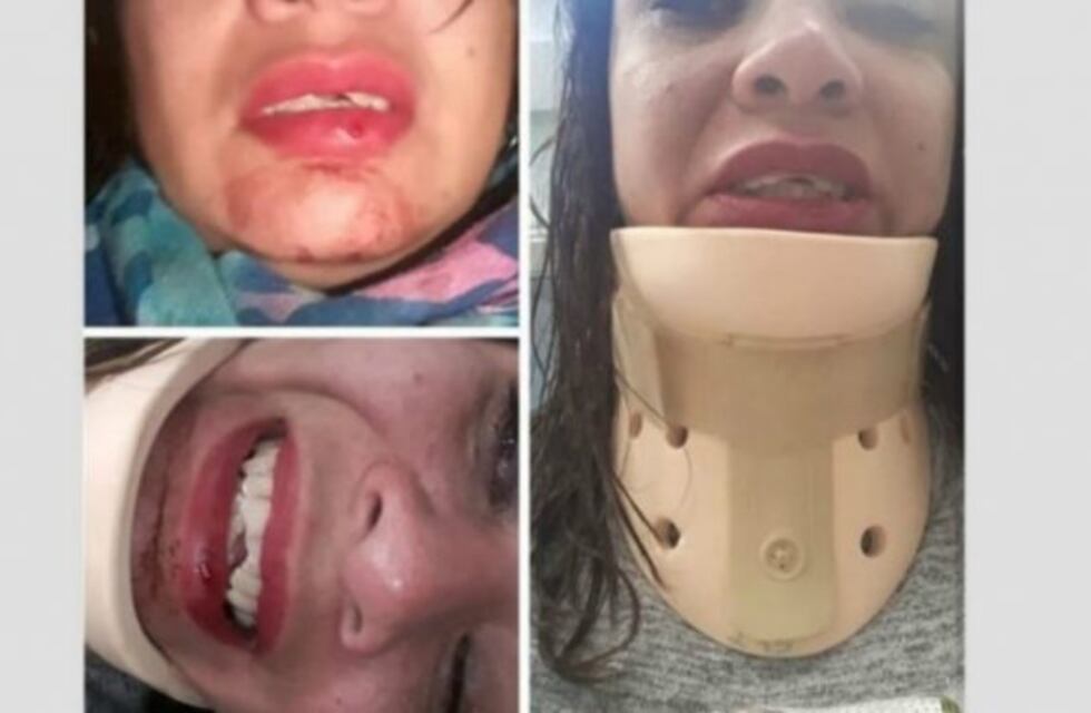 Iba a su despedida de soltera y le rompieron los dientes en un asalto