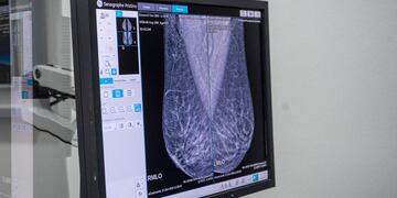 La mamografía y los controles periódicos son esenciales para la detección precoz del cáncer de mama.