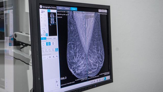 La mamografía y los controles periódicos son esenciales para la detección precoz del cáncer de mama.