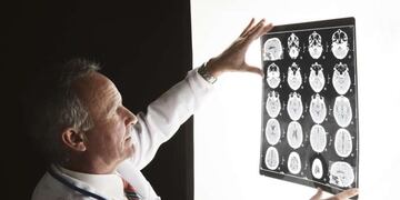 Alzheimer: se producen cambios cerebrales dos décadas antes de que haya síntomas