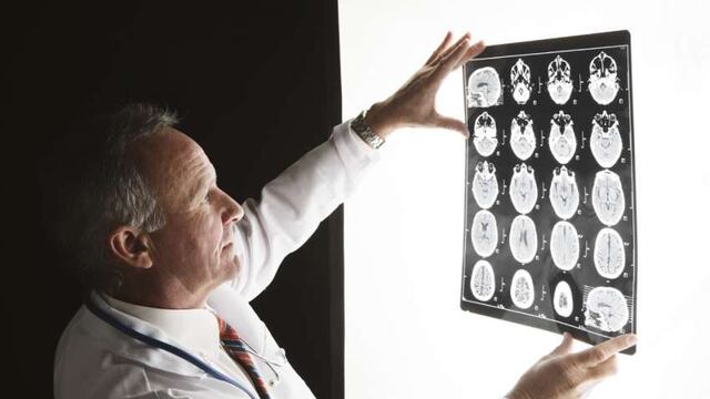 Alzheimer: se producen cambios cerebrales dos décadas antes de que haya síntomas