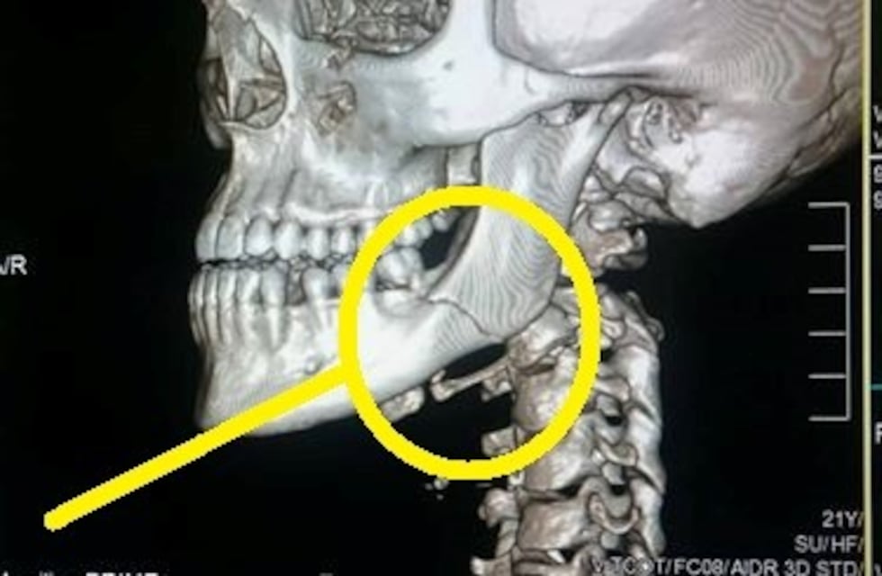 Una joven fue golpeada salvajemente por un agresivo hombre hasta fracturarle la mandíbula