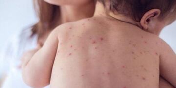 Alertan sobre un brote de sarampión: recomiendan la vacunación