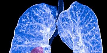 23/05/2017 Cáncer de pulmón\u002E Una nueva investigación dirigida por científicos de la Unidad de Toxicología del Consejo de Investigación Médica (MRC, por sus siglas en inglés), en Reino Unido, sugiere que, al analizar los niveles de ADN en la sangre, podría mejorarse la detección temprana del cáncer de pulmón\u002E ESPAÑA EUROPA MADRID SALUD ATS