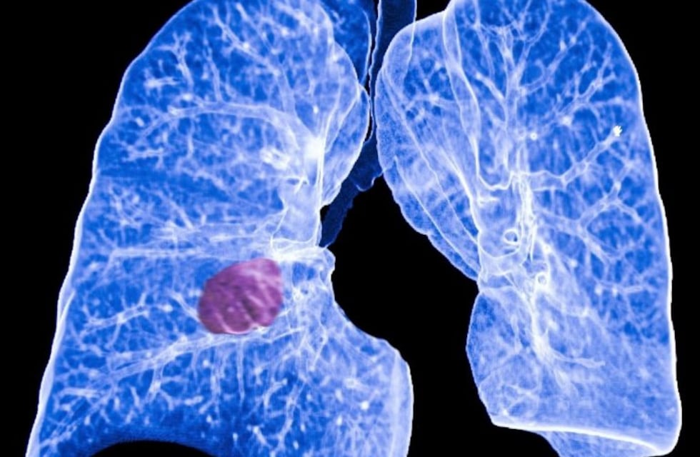 Afirman que la inmunoterapia elimina los rastros de cáncer de pulmón en el 80% de los casos