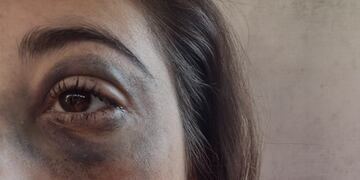Marcas. Yésica Brusa denunció una golpiza policial.