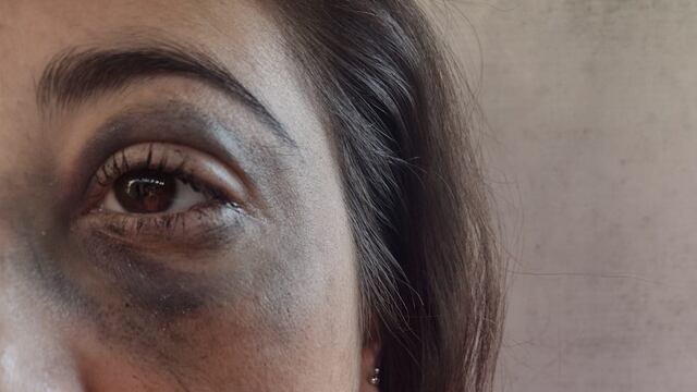 Marcas. Yésica Brusa denunció una golpiza policial.