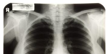 Radiografía\u002E Imagen ilustrativa\u002E