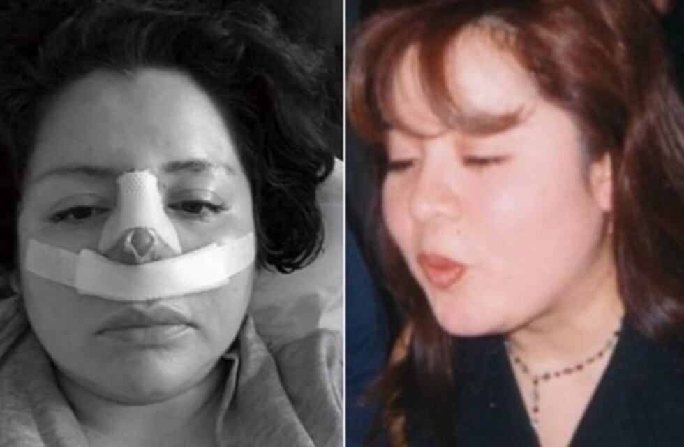 Fue a hacerse una liposucción y el cirujano le operó la nariz sin preguntarle