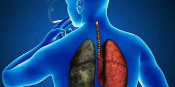 Muchos casos de cáncer de pulmón que podrían ser tratados pasan desapercibidos\u002E